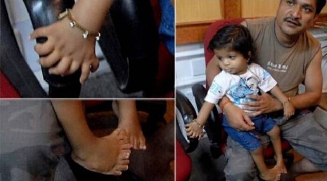지난 2011년 인도에서 손가락 14개, 발가락 20개를 가진 1살 남자아이가 기네스북에 올랐다.