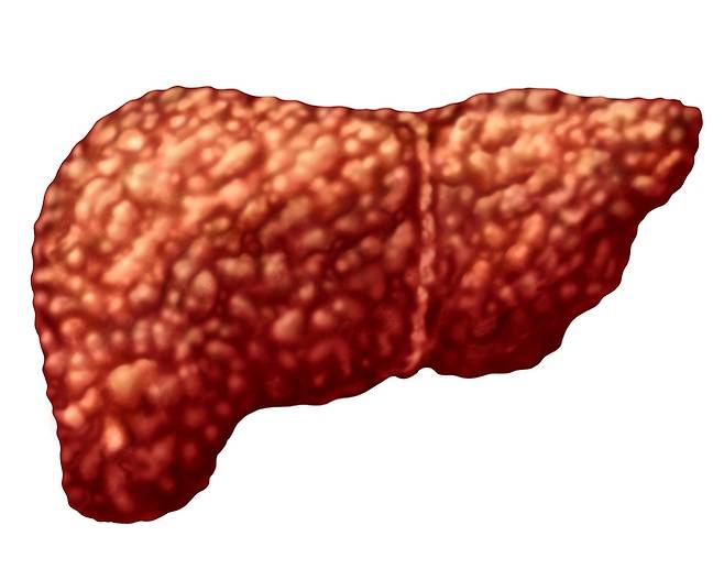비알코올성 지방간(NAFLD)이 있는 환자는 성격 장애가 있을 가능성이 3배나 높다는 연구 결과가 나왔다./사진=게티이미지뱅크