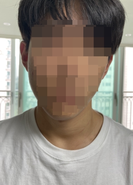 ▲ 오른쪽 뺨이 부은 피해 학생 얼굴 사진 : 연합뉴스