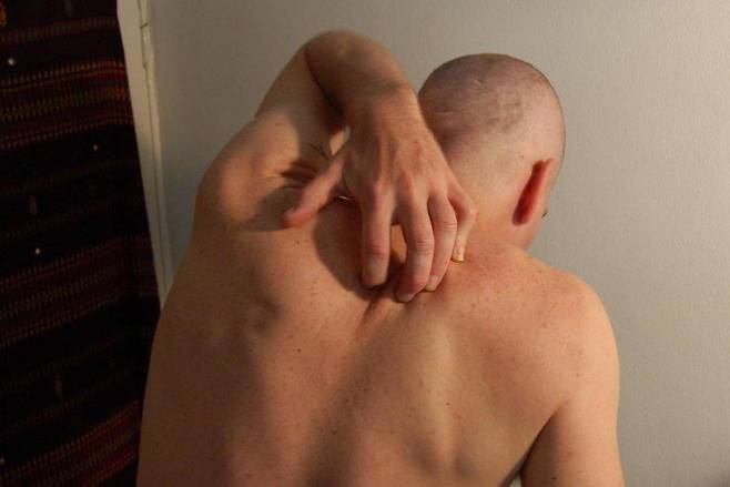 피부질환 환자의 42%가 수면 장애를 경험한다는 연구 결과가 나왔다. 이 때문에 피부질환을 진료할 때 수면 장애도 함께 검사해야 할 필요성이 제기되고 있다./연구팀 제공