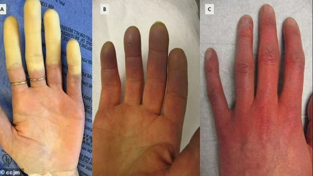레이노 증후군에 걸리면 손발에 3단계 색깔 변화가 나타난다./사진=데일리메일 캡처