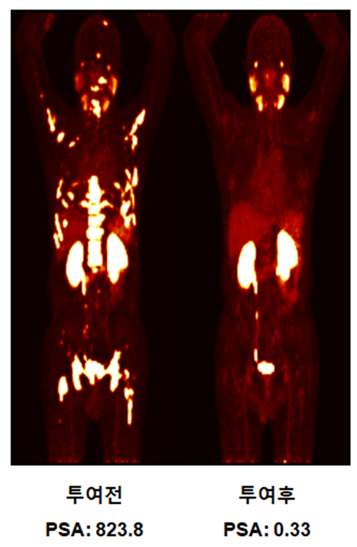 전립선암 환자의 PET CT 사진,.PSMA단백질이 발현된 전립선암이 Lu-177-DGUL 투여후 소멸 치료되었고 혈중 PSA수치도 정상수치로 회복됐다. <사진제공=셀비온>