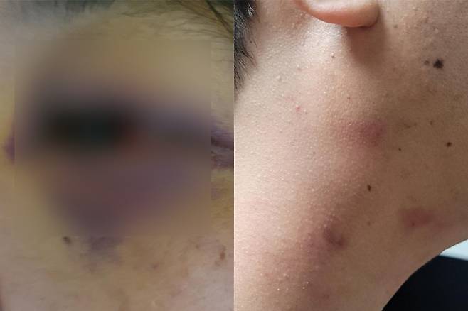 폭행피해로 글쓴이 남편의 눈과 목에 남은 상처. 보배드림 캡처