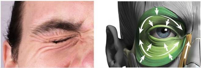 < 눈가를 찌푸리는 눈둘레근(안륜근)도 눈썹을 아래로 끌어내린다. [사진=anatomy 캡처]" width="580">이마근(전두근)은 눈썹은 위로 끌어올리고, 눈썹주름근(추미근), 눈둘레근(안륜근)은 눈썹을 아래로 끌어내립니다. 이렇게 서로 반대 방향으로 작용하는 근육을 '길항근'이라고 합니다. 이마는 길항근들이 반대 방향으로 작용하며 위치를 유지하고 있습니다. 이때 아래로 끌어내리는 근육을 보톡스로 약화시키면, 올라가는 힘을 더 받는 방향으로 균형이 기울어지게 됩니다. 무겁던 눈썹이 가벼워지면서 눈썹을 치켜뜰 필요가 줄어드니 이마의 주름 역시 개선되는 것입니다.