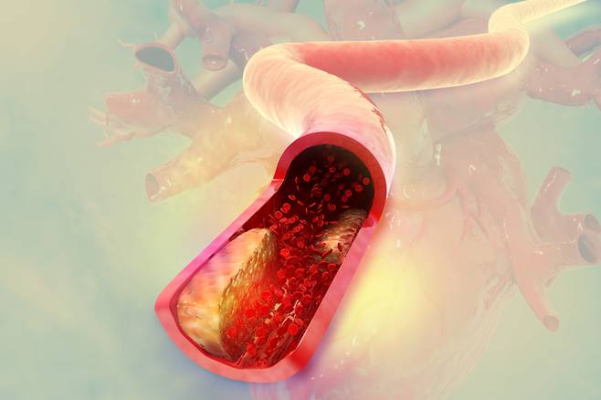 이상지질혈증의 원인은 동물성 지방 섭취, 탄수화물 과다 섭취, 음주, 흡연, 스트레스, 운동 부족, 연령 증가 등이 꼽힌다. [사진= 게티이미지뱅크]