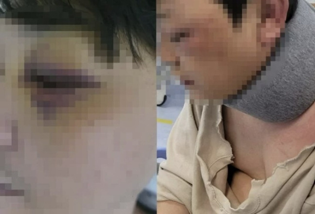 초등생 학부모에게 구타당해 얼굴과 목 등에 부상을 입은 B씨. [보배드림]