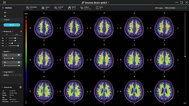 [서울=뉴시스] 2일 의료 인공지능(AI) 솔루션 기업 휴런은 치매 분석 AI 솔루션 '뷰론-브레인-피에이비쓰리(pAb3)'이 미국 식품의약국(FDA) 510(k) 인증을 획득했다고 밝혔다. (사진=휴런 제공) 2023.11.02. photo@newsis.com *재판매 및 DB 금지