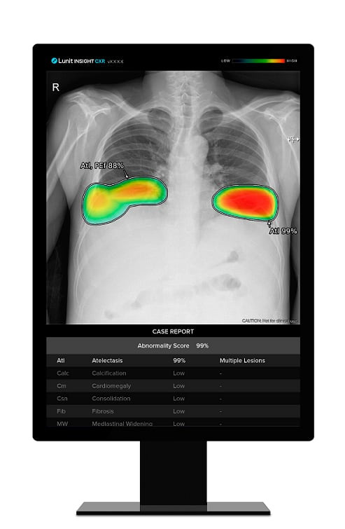 루닛 흉부 엑스레이 AI 영상분석 솔루션 '루닛 인사이트 CXR./루닛 제공