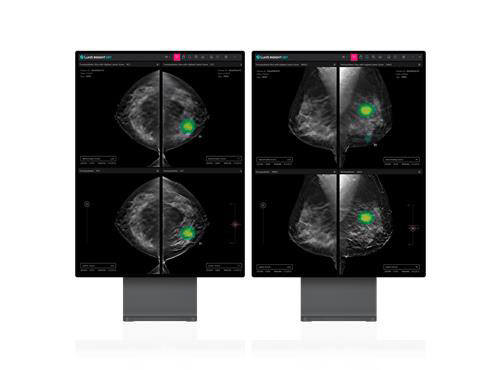 유방단층촬영술 AI 영상분석 설루션 '루닛 인사이트 DBT' 루닛 제공.