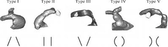 폐동맥 판막 질환의 다양한 우심실 유출로 모양(출처: Circ Cardiovasc Imaging. 2014;7:182-189).