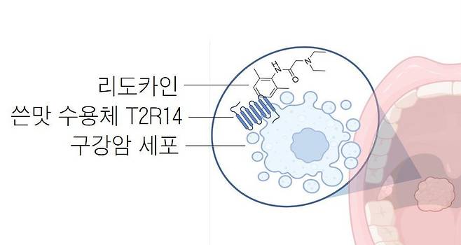 미국 펜실베이니아대 의대 연구진이 치과, 외과에서 국소마취할 때 쓰는 약물 리도카인이 암세포를 죽이는 효과가 있다는 사실을 알아냈다. 리도카인은 신경전달을 차단해 통증을 없애는 약물이다./펜실베이니아대 셀리포트