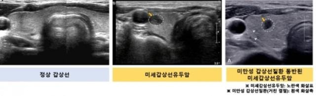 갑상선 초음파검사 장면. 왼쪽 사진부터 정상 갑상선, 미세 갑상선 유두암, 미만성 갑상선 질환이 동반된 미세 갑상선 유두암. 서울대병원 제공