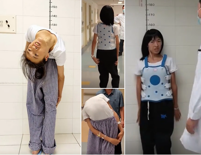 척추가 180도 뒤로 꺾인 여성이 마침내 수술을 받고 똑바로 설 수 있게 됐다. 26년 전 척추가 180도에 가깝게 휘어진 후 두 손으로 자신의 머리를 지지해야 할 정도로 힘든 생활을 이어왔다.[사진=영국 일간 더선 보도내용 캡처 갈무리]