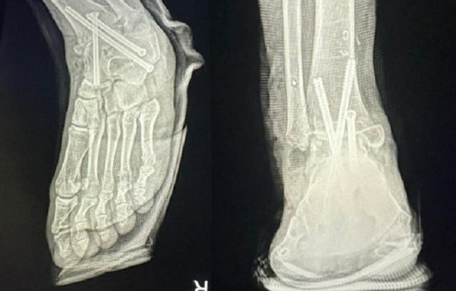 병원 실수로 멀쩡한 발목뼈를 절단해 철심 3개를 박은 모습. /사진=연합뉴스
