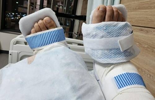 병원 실수로 양다리 모두 불구가 된 A씨. 연합뉴스