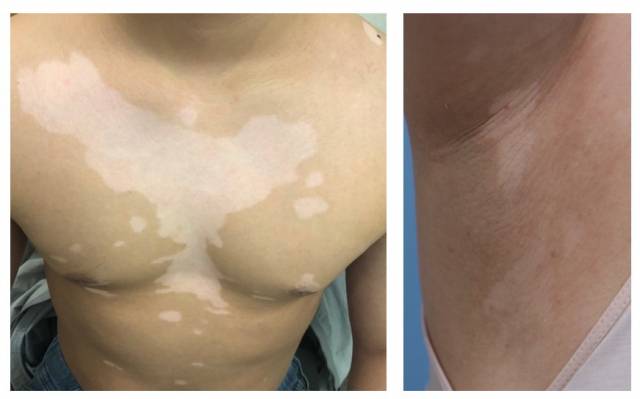 가슴(왼쪽) 및 겨드랑이 부위에 병변이 발생한 백반증 환자. 사진 제공=서울대병원