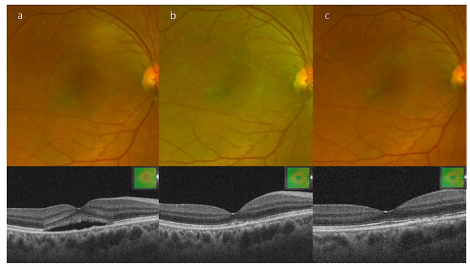 만성 중심장액맥락망막병증 진단을 받은 44세 남자 환자의 비손상 역치하레이저 치료 전후 망막 사진. (좌)망막하액 병력이 관찰된 지 4개월된 망막사진 (중)비손상 역치하레이저 치료를 시행한지 3개월 경과 망막사진, (우)비손상 역치하레이저 치료 6개월 경과 후 망막사진. 비손상 역치하레이저 치료 후 6개월이 경과한 맨 우측 검사결과상 망막하액 소견이 관찰되지 않음을 확인할 수 있다.