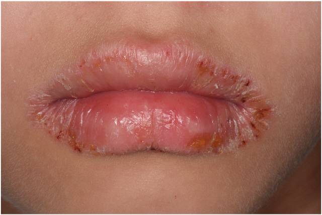 입가가 트고 따끔거리는 구순염은 비타민B2가 부족할 때 잘 생긴다./사진=치과학저널(Journal of Dental Sciences)