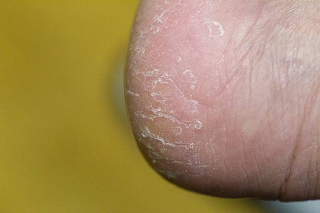 각화형 무좀은 각질이나 굳은살과 외형이 매우 흡사해 알아차리기 쉽지 않다./사진=게티이미지뱅크