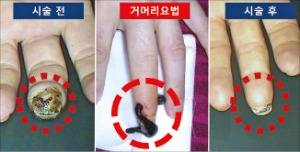 버거씨병 환자에게 적용한 거머리요법의 시술 전후 사진. 거머리요법은 소염진통, 혈액순환촉진, 면역안정, 조직재생 효과가 있다. 한동하한의원 제공