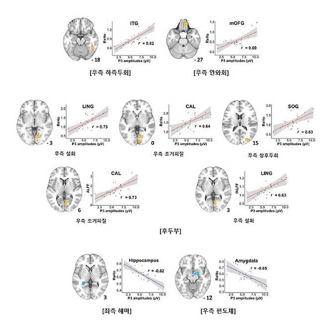 기능적 MRI와 뇌파검사 결과 우측 하측두회, 우측 안와회 및 일부 후두부에서 모두 유의미한 양의 상관관계를 보였다(노란색/빨간선). 좌측 해마와 우측 편도체에서는 두 검사 결과 사이의 음의 상관관계를 보였다(파란색)>