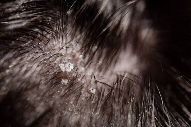 비듬에도 종류가 있으며, 종류에 따라 관리법을 달리해야 한다./사진=게티이미지뱅크