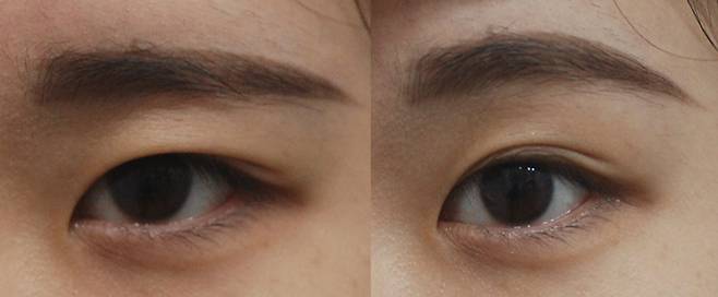 쌍꺼풀은 이미 예쁘게 잡혀 있습니다. '내시경 이마 눈썹 거상'으로 눈썹을 올려주면 자연스러운 눈이 되므로, 눈 수술은 필요하지 않습니다.