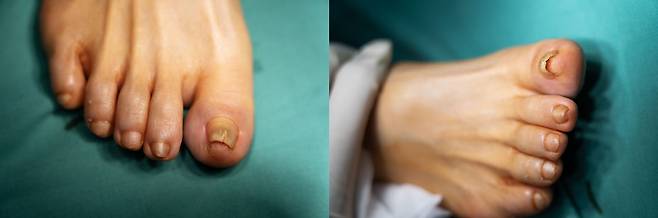 엄지발가락의 내성발톱./사진=210정형외과 제공