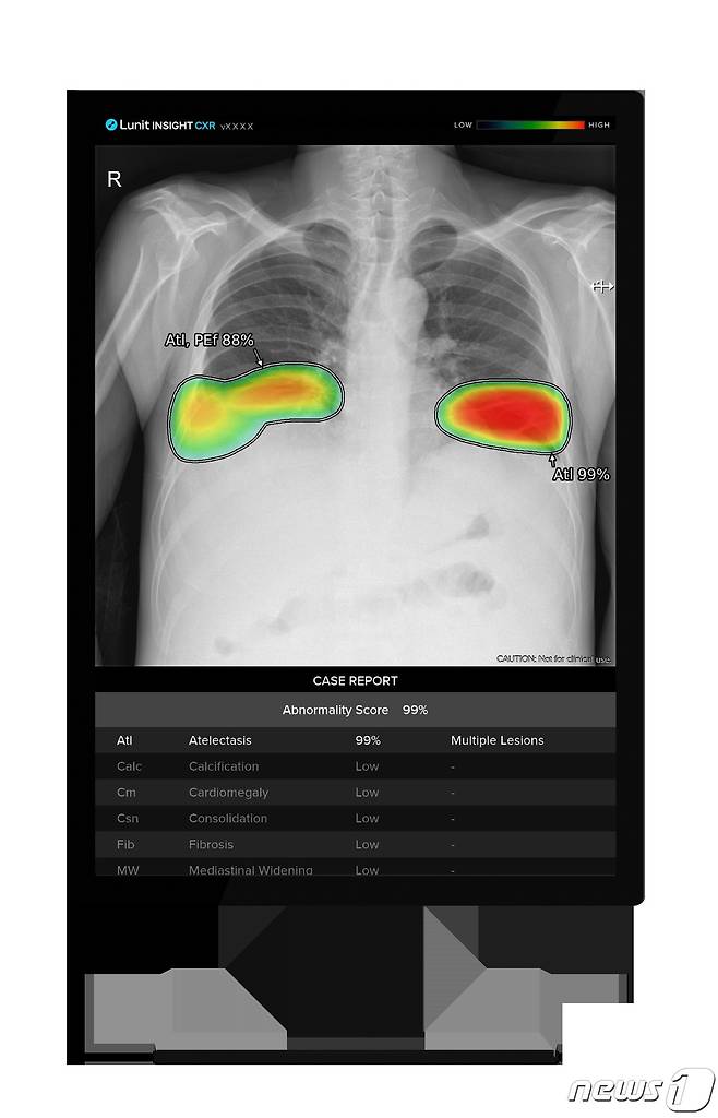 루닛 인사이트 CXR 활용 모습.(루닛 제공)/뉴스1 ⓒ News1