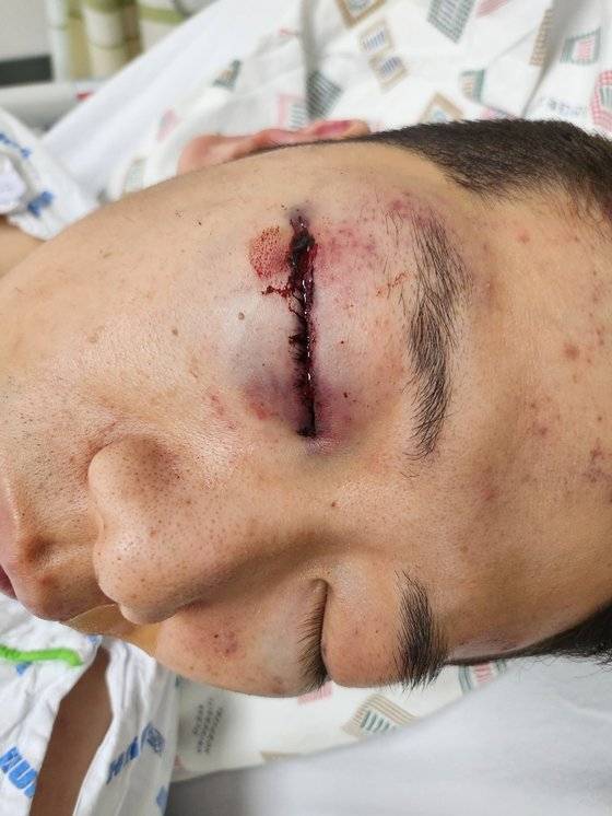 한국알콜산업 내에서 화물연대 조합원인 동료 직원에게 폭행당한 A씨. 눈 등 얼굴이 크게 다쳐 두달째 병원 치료를 받고 있다. 사진 A씨