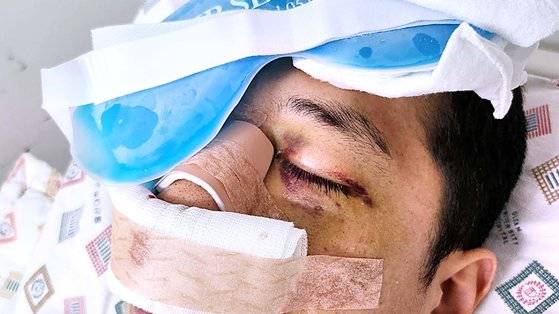 한국알콜산업 내에서 화물연대 조합원인 동료 직원에게 폭행 당한 A씨. 눈 등 얼굴이 크게 다쳐 두달째 병원 치료를 받고 있다. 사진 A씨