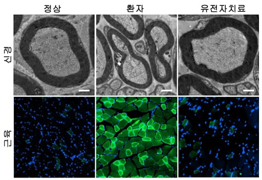 염수청 서울대 국제농업기술대학원 교수와 최병옥 삼성서울병원 신경과 교수 연구진이 희귀난치성 신경질환인 샤르코 마리 투스병 2Z(CMT2Z)의 발병원인을 최초로 밝히고, 환자 맞춤형 유전자 치료법을 세계 최초로 개발했다. 사진은 CMT2Z 시료에 유전자 치료제를 적용한 결과./서울대