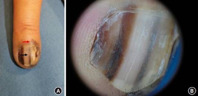 손톱 아래에 검은색 세로줄이 있거나 손톱이 까맣게 변한다면 흑색종을 의심해야 한다./사진= Archives of Hand and Microsurgery