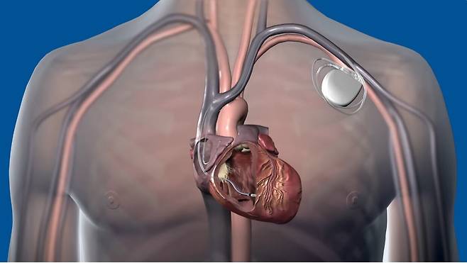 메드트로닉이 출시한 이식형 제세동기 '코발트XT'를 환자의 몸에 삽입한 모습을 그린 일러스트./메드트로닉