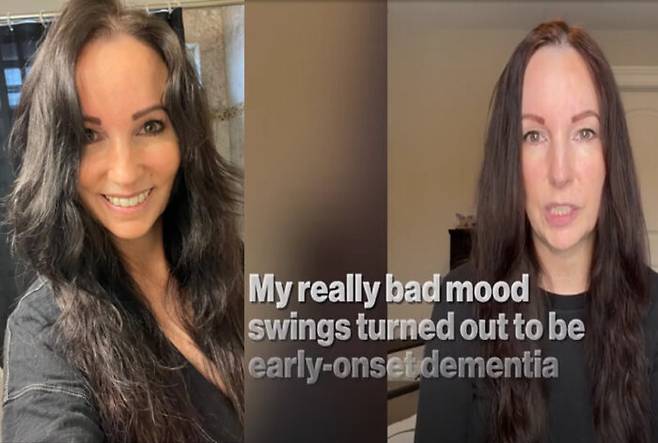 심한 감정기복에 시달리던 여성이 조기 발병 치매(early-onset dementia) 진단을 받은 사연이 공개됐다. [사진='뉴욕포스트' 보도내용 캡처]