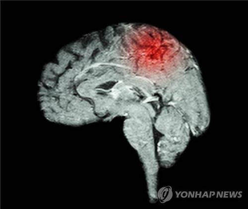 뇌졸중 [게티이미지뱅크 제공]