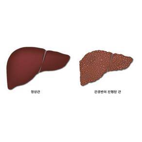 간경화 [출처: 삼성서울병원]