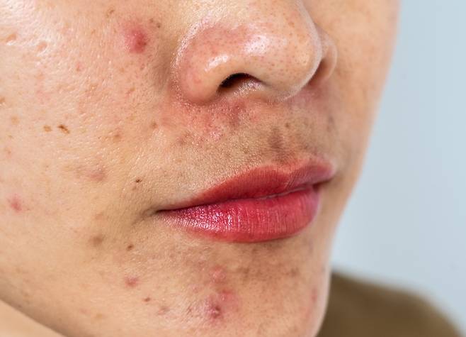 딱딱한 결절성 여드름을 손으로 짰다간 흉터가 남을 수 있어 피부과에서 치료받는 게 좋다./사진=게티이미지뱅크