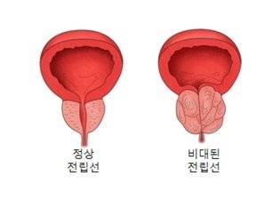 정상 전립선과 비대된 전립선. 사진 서울아산병원