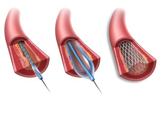 심장 혈관 스텐트 시술. 사진 서울아산병원