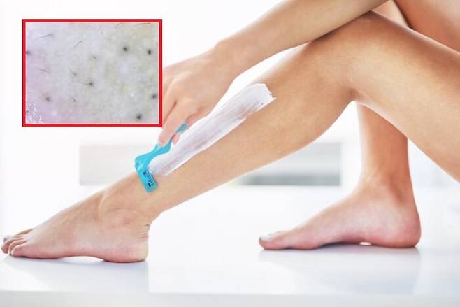 피부 속 까만 점처럼 보이는 털을 '인그로운헤어(In Growon Hair)'라 한다. [사진=게티이미지뱅크 / Indian Dermatology Online Journal ]