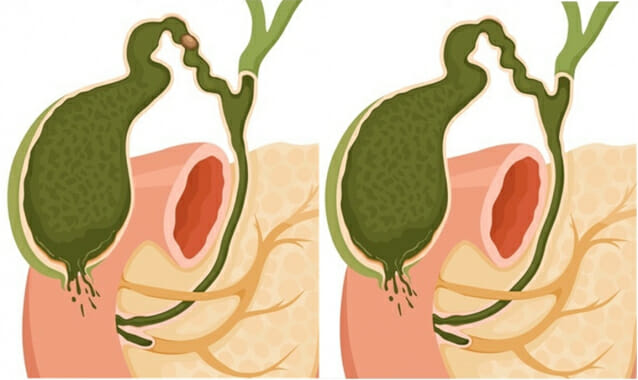왼쪽이 결석성 급성담낭염, 오른쪽이 무결석성 급성담낭염. (일러스트=한림대의료원)