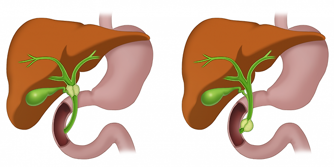 간과 십이지장을 잇는 담관(녹색)은 담낭 부위(왼쪽)나 십이지장 부위(오른쪽) 등 다양한 곳에 암이 생길 수 있다.