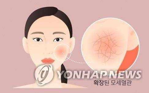 안면홍조 [건강보험심사평가원 제공]