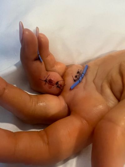 앨리슨 리는 지난달 남자친구의 애완견에 왼손을 물려 봉합 수술을 받았다.[사진제공=골프위크]
