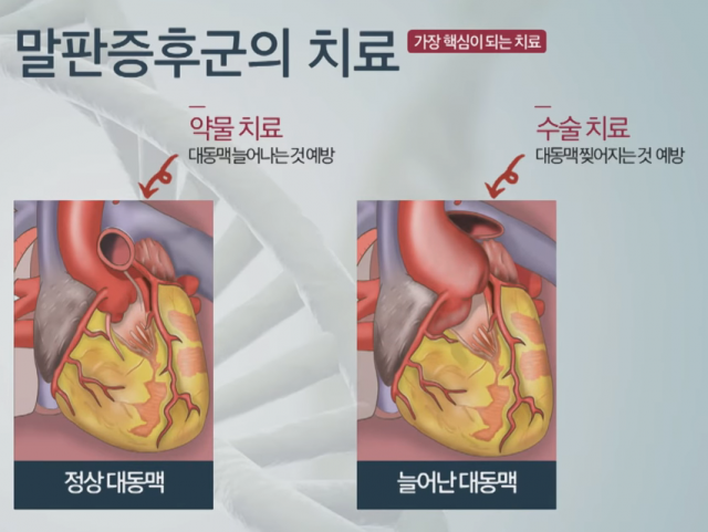 말판증후군의 치료. 사진 제공=삼성서울병원