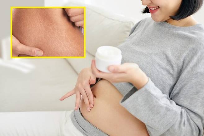 튼살의 정식 의학용어는 '팽창선조'다. 피부 흉터의 일종인 튼살은 진피층이 팽창돼 피부 중간층을 이루는 콜라겐 조직이 찢어져 피부 위로 비친 상태다. [사진=게티이미지뱅크]