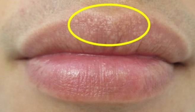 주로 입술에 많이 생기는 피지샘이 원래 있어야 할 곳이 아닌 다른 부위에 위치해 생기는 반점이다./사진=헬스조선 DB