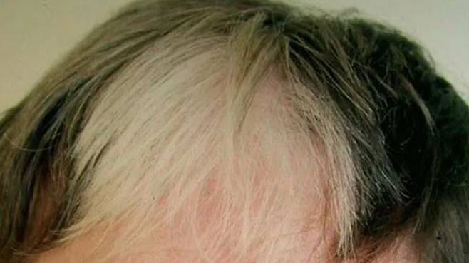 하얀 머리카락이 나타나는 범위는 사람마다 다르며, 머리카락 전체가 백발이 될 수도 있다./사진=Healthline