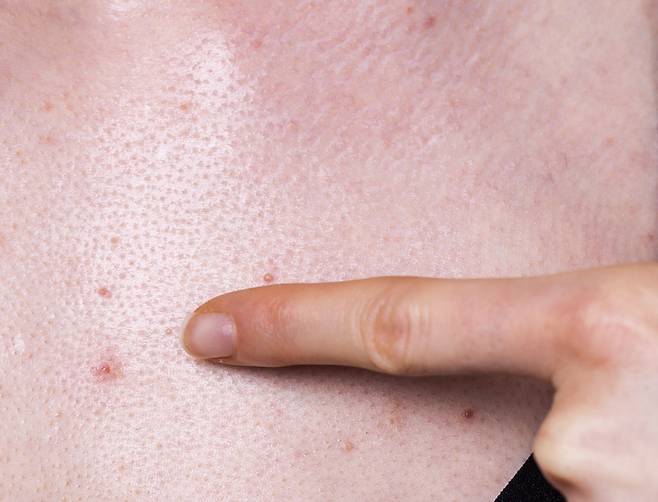 여드름은 얼굴에만 생긴다고 생각하기 쉽지만, 몸에도 여드름은 생긴다./사진=클립아트코리아